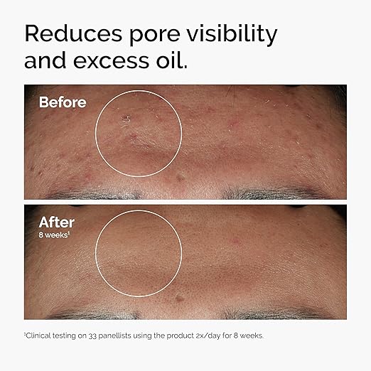 The Ordinary Niacinamide Serum [buy 1 Get 1 Free]